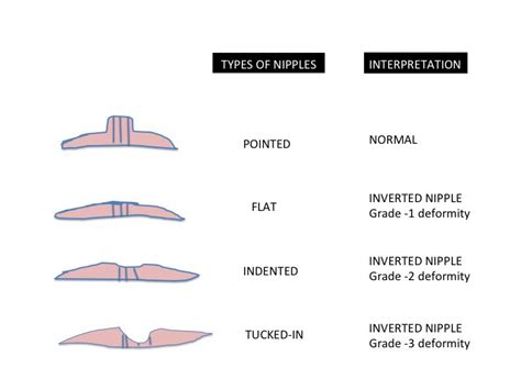 newly inverted nipple|Inverted & Flat Nipples: Causes & Treatment